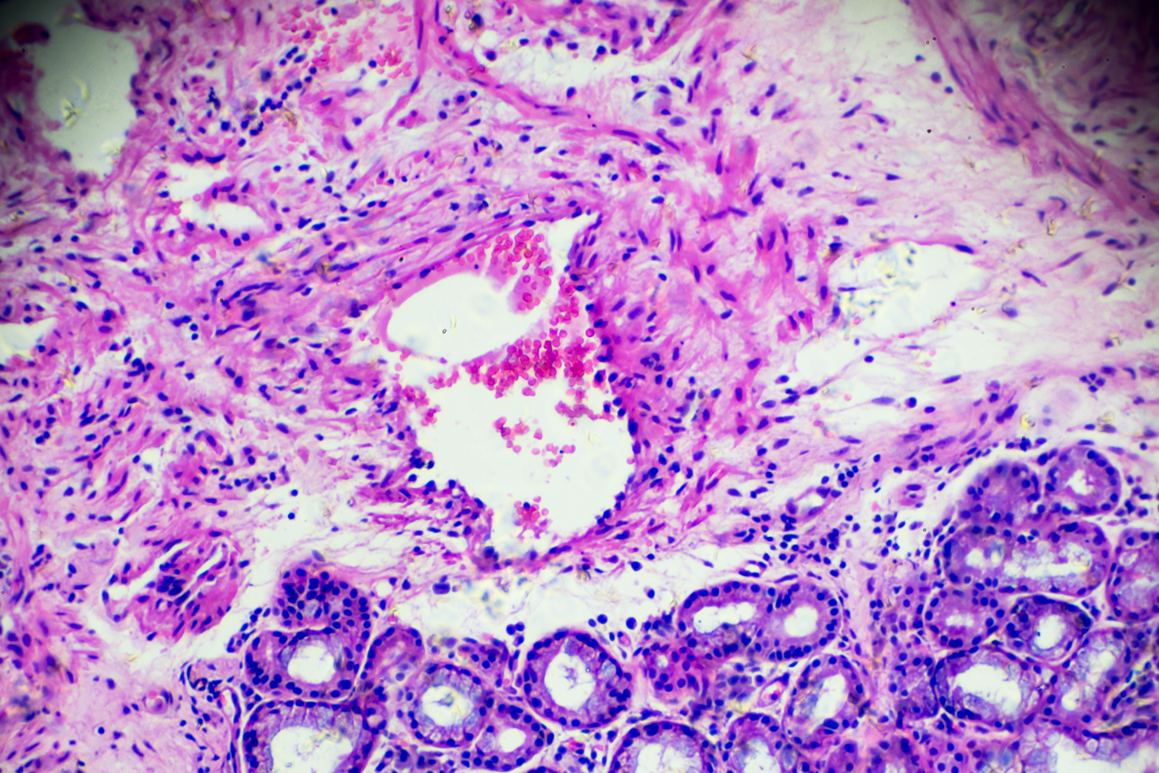 inflammation stock image